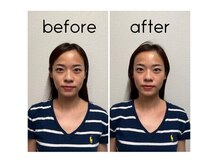 ベレディオ鍼灸整骨院(Belledio鍼灸整骨院)の雰囲気（美容鍼+小顔矯正ごのビフォーアフターです！大阪美容鍼　 　）