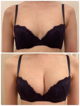 美人バスト 渋谷店/【バストアップ・育乳】症例☆