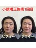 【女性写真掲載モニター】★小顔矯正★¥14300⇒¥4900【平日の17時開始まで】