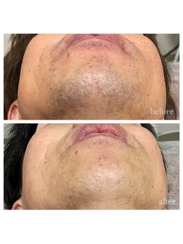 ハピネスビューティーサロン(happiness beauty salon)/脱毛/メンズ/レディース