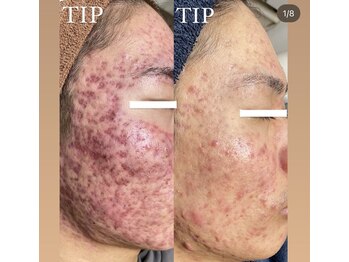 ムーンリズム(Moonlism)/【TIPハーブ症例】ニキビ/肌荒れ