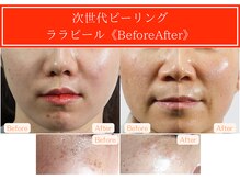 Cスキンケアクリニック 麻布店/ララピールBeforeAfter #赤羽橋