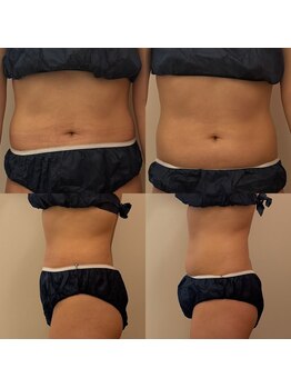 ホロニック ベルサンテ(Holonic Belle Sante)/脂肪/引き締め/サイズダウン