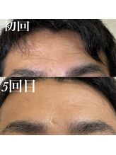 コリー(Kolly)/デコジワさよなら～