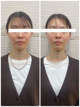 長寿鍼灸院 長寿整骨院/左右非対称のお顔に美容鍼★50本