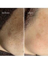 マーギアー(Magier)/ハーブ＋ダーマ　初来店→４回目