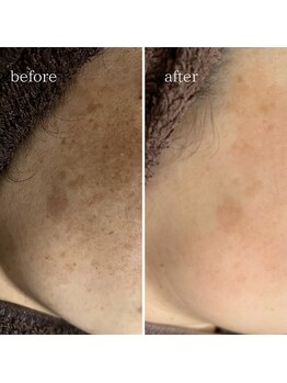 マーギアー(Magier)/ハーブ＋ダーマ　初来店→４回目