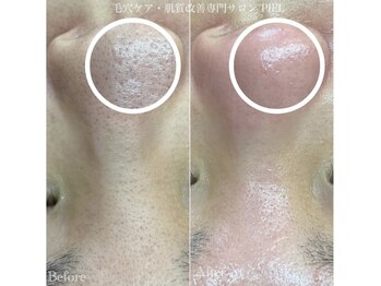 ピエル 北千住店(PIEL)/うぶ毛にお悩みの方