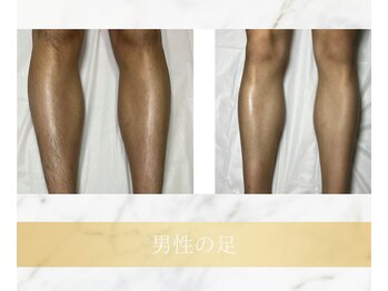 アンド エヌ(&n)/◆足脱毛◆