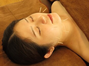ジネコラボ 新橋汐留店(Gyneco-labo)/【美容鍼灸】フェイスラインも♪