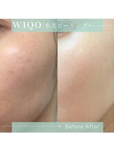 リノア 柏(Lino'a) WiQo O 水光ピール
