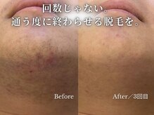 ダイヤ 名古屋中川区店(Daiya)/メンズ脱毛/ヒゲ【BeforeAfter】