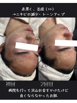 リヴィア(LIVIA)/メンズOK◎ニキビケアも!