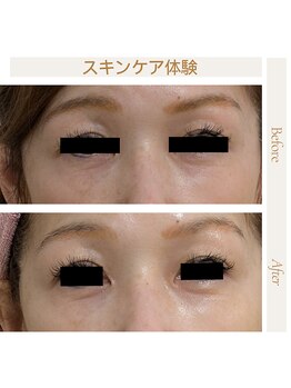 ミヤビ(miyabi)/ルネセルスキンケア体験