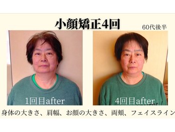 RKY/小顔矯正&頭蓋骨矯正4回(60代)