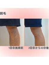 クレアナ ザ ビューティー(KULEANA the beauty)/光脱毛