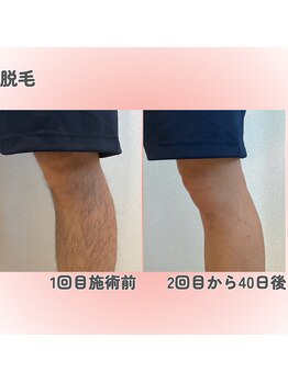 クレアナ ザ ビューティー(KULEANA the beauty)/光脱毛