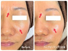 フェイシャルエステ エムズルーム(M's room)/ハーブピーリング＊小じわ改善