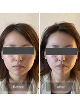 リノリー(rinory)/小顔コルギ