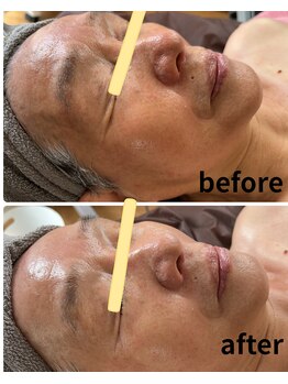 カリュール(K'allure)/80歳のお肌も１回で艶肌へ