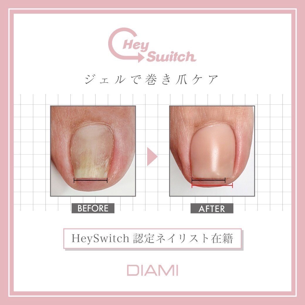 Hey Switch 巻き爪ケアジェル：PG012169237｜エム ネイル(M nail)の