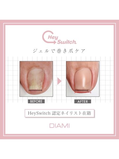 Hey Switch 巻き爪ケアジェル：PG012169237｜エム ネイル(M nail)の 