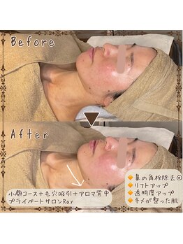 プライベートサロン レイ(Ray)/小顔コース+毛穴吸引+背中