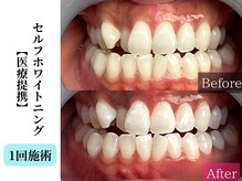 ベルホワイト(Belle White)/【医療提携W.N/１回】