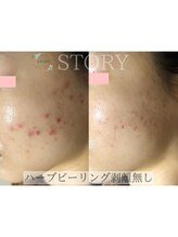 ストーリー 沼津店(STORY)&nbsp;ハーブ ピーリング
