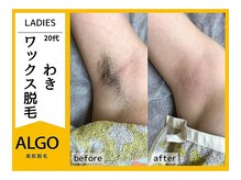アルゴ 南茨木駅前店(ALGO)/【アルゴ式WAX脱毛＋光脱毛】