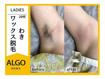 アルゴ 南茨木駅前店(ALGO)/【アルゴ式WAX脱毛＋光脱毛】