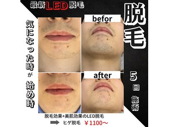 リノミラ(LINOMIRA)/メンズ人気No,1　ヒゲ脱毛