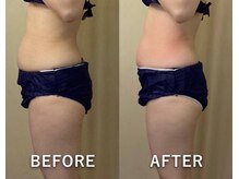 ヒトハナ(hitohana)/２回目の施術でこの効果◎