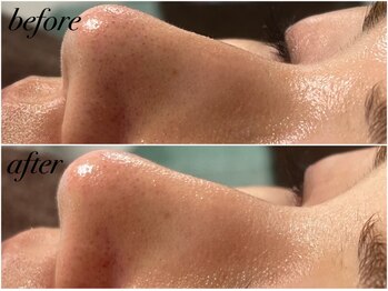 アンドナイン エス店(ANDNINE.)/◆毛穴洗浄 1回