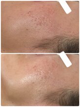 ビジュープラス 幸手店(Bijou+)/シワ・毛穴ケア