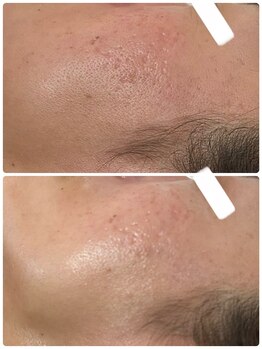 ビジュープラス 幸手店(Bijou+)/シワ・毛穴ケア