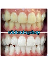 ホワイトニングショップ 吉祥寺2号店/歯の黄ばみを気にして笑えない方