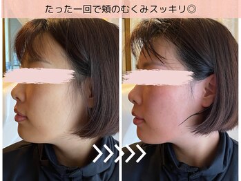 ヨサパーク ミィ(YOSA PARK mii)/即実感！水素吸入で小顔に◎