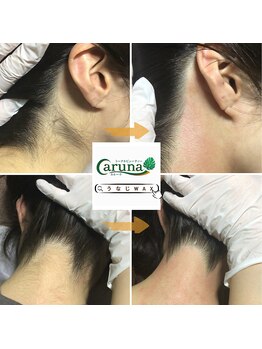 トータルビューティー カルーナ/うなじMIX脱毛★