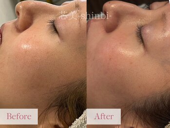 芯美 恵比寿店(shinbi)/施術8回/肌荒れ/毛穴開き/敏感肌