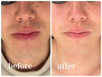 エリクサー 加須店(Elixir)/12回の照射でツルツル目指そう！