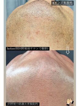 クレヴィー(Creviy)/ヒゲ脱毛7回照射の経過