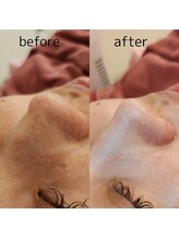 レイネイル レイエステティック 岐阜茜部店(RAY NAIL & RAY ESTHETIC)/"新"毛穴角栓洗浄