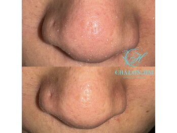 シャロンドットエイチエム(CHALON.HM)/毛穴洗浄＋モデリングパック