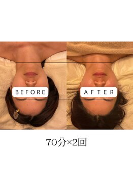 ファミーユ 名古屋店/【フェイシャル小顔、術後ケア】