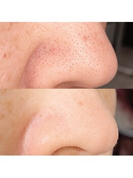 アイビーケア 三田(ivy care)/毛穴洗浄