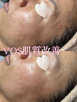 ティアーナ(Tiaana)/肌質改善VOSサロンケア