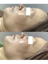 エミルカ 仙台(EMILUCA)/つや玉リフトフェイシャル