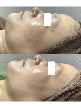 エミルカ 仙台(EMILUCA)/つや玉リフトフェイシャル