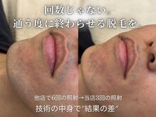 ダイヤ 名古屋中川区店(Daiya)/メンズ脱毛/ヒゲ【BeforeAfter】